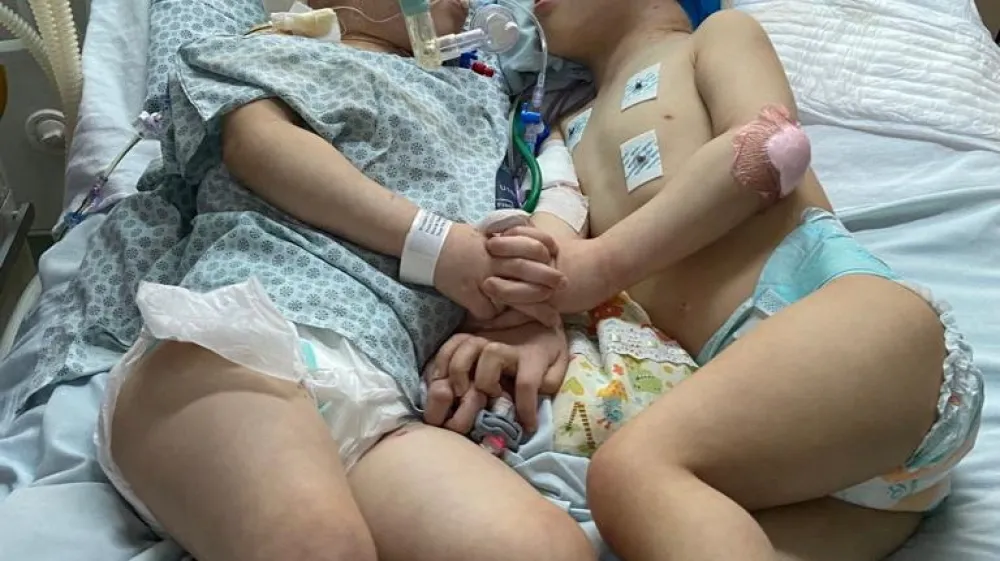 Formerly conjoined twins, Bernardo and Arthur Lima, lie in a hospital bed after a successful separation surgery, in Rio de Janeiro, Brazil July 2022. Gemini Untwined & Instituto Estadual do Cerebro Paulo Niemeyer/Handout via REUTERS  THIS IMAGE HAS BEEN SUPPLIED BY A THIRD PARTY. NO RESALES. NO ARCHIVES. MANDATORY CREDIT