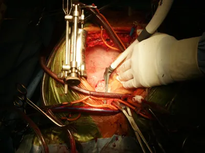 prof. dr. Borut Ger&scaron;ak, kardio kirurg in predstojnik oddelka za kirurgijo srca in ožilja- operacija srca, srcna zaklopka, zdravnik, bolnica, bolnik, pacient, srce, instrumentiFOTO: JAKA GASAR / NEDELJSKI