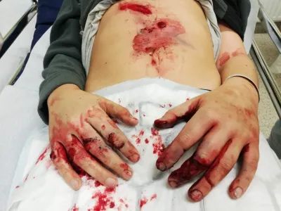 Po&scaron;kodovana roka zaradi uporabe pirotehnike. F Policija