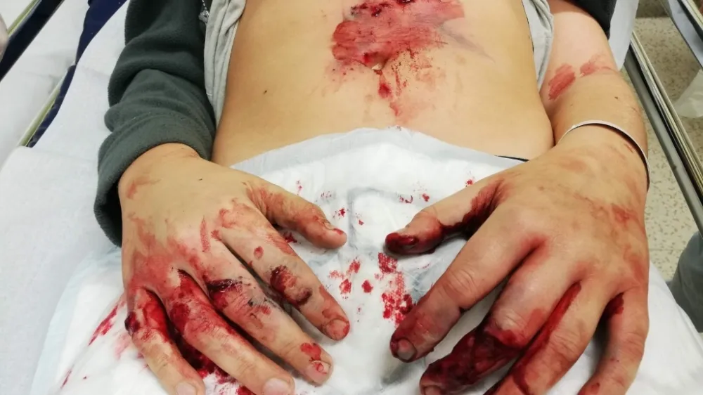 Po&scaron;kodovana roka zaradi uporabe pirotehnike. F Policija