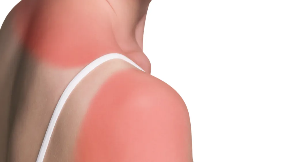 Sunburn female shoulder isolated on white background