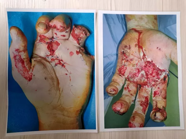 Po&scaron;kodbe so lahko zelo hude in nepopravljive. Foto: policija