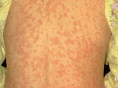 Nalezljiva bolezen o&scaron;pice