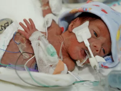 Jerrick De Leon, nedono&scaron;enček najmanj&scaron;i dojenček na svetu tehtal 680 dekagramov