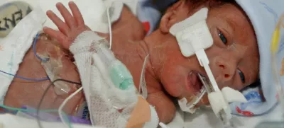 Jerrick De Leon, nedonošenček najmanjši dojenček na svetu tehtal 680 dekagramov