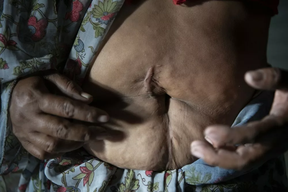 Archana Ashok Chaure, a sugarcane laborer and mother of 3 who has not been able to work without pain since a hysterectomy, shows her surgery scars at her family's home in Kawadgaon, India, on May 21, 2023. When Chaure's husband took her to the cane fields after their wedding, she hoped they would be done in a season. That was more than 15 years ago. They are still in debt.,Image: 859358118, License: Rights-managed, Restrictions:, Model Release: no