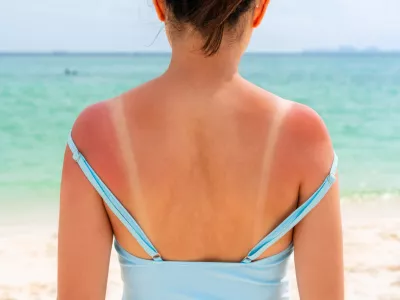 Posebej izpostavljena so ramena.