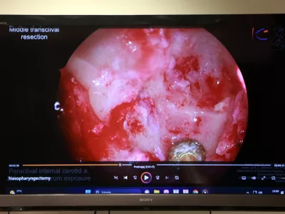 11.07.2025 - novinarska konferenca UKC Ljubljana in Onkolo&scaron;kega in&scaron;tituta Ljubljana, na kateri bodo predstavili prvo endoskopsko kirur&scaron;ko odstranitev raka nosnega dela žrela z rekonstrukcijo, ki so jo uspe&scaron;no izvedli kirurgi Klinike ORL UKC Ljubljana, sodelovali bodo specialista otorinolaringologa Domen Vozel in Jure Urbančič, glavna medicinska sestra ORL Klinike Polona Travnikar Pouh, predstojnik Klinike za ORL Robert &Scaron;ifrer in specialist onkologije z radioterapijo Gaber Plavc; Klinika za ORL, Foto: Tomaž Skale
