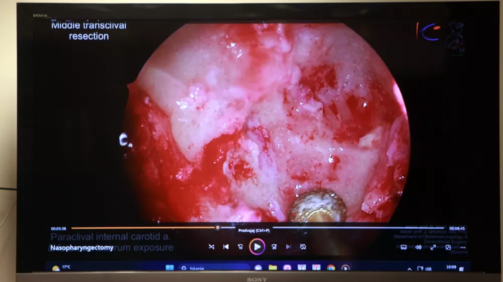 11.07.2025 - novinarska konferenca UKC Ljubljana in Onkolo&scaron;kega in&scaron;tituta Ljubljana, na kateri bodo predstavili prvo endoskopsko kirur&scaron;ko odstranitev raka nosnega dela žrela z rekonstrukcijo, ki so jo uspe&scaron;no izvedli kirurgi Klinike ORL UKC Ljubljana, sodelovali bodo specialista otorinolaringologa Domen Vozel in Jure Urbančič, glavna medicinska sestra ORL Klinike Polona Travnikar Pouh, predstojnik Klinike za ORL Robert &Scaron;ifrer in specialist onkologije z radioterapijo Gaber Plavc; Klinika za ORL, Foto: Tomaž Skale