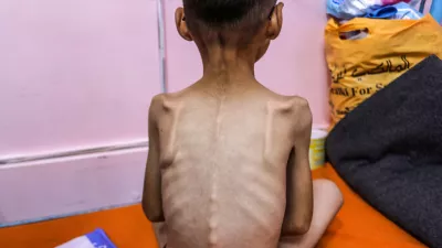 08 August 2025, Palestinian Territories, Gaza: A Palestinian child suffering from severe malnutrition pictured in Nasser Medical Hospital, As Israel continues the closure of the crossings and the non-allowing of humanitarian aid and infant formula to enter the Gaza Strip. Photo: Abed Rahim Khatib/dpa