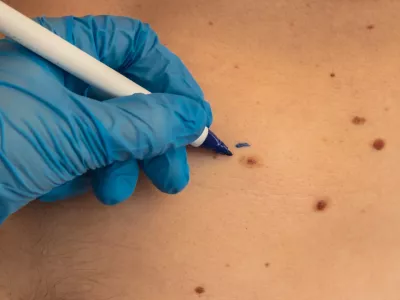 Doctor in medical gloves paint lines around male birthmarks. Preparing procedure for medical surgery. Laser skin tags removal. Prevention of melanoma and nevus exam / Foto: Anastasiia Yanishevska