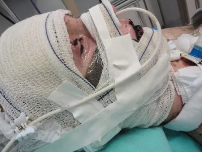 EXCLUSIVE: Story from Jam Press (Steven Johnson Syndrome) Woman left 'burning from inside out' after taking Ibuprofen devastated as doctors say vision is lost for goodA woman who was left 'burning from the inside out' and in a 17-day coma from an extreme reaction to Ibuprofen will never get her sight back, doctors have confirmed.Jaqueline Gmack took the over-the-counter medication to alleviate menstrual cramps, but soon started to experience terrifying symptoms, including blistering skin.The 32-year-old was taken to hospital and put into an induced coma, with doctors discovering her body's reaction to the medication had triggered a rare condition called Stevens-Johnson syndrome (SJS).It was a "miracle" she survived the traumatising incident, but despite 26 operations to save her vision, doctors have recently confirmed the vision in her right eye is lost for good, and vision in her left eye is extremely limited."It has taken a while for the reality to sink in &ndash; I entered a period of real mourning," Jaqueline, from Papanduva, Brazil, told NeedToKnow."I don't recognise faces on the street, I can barely see who's next to me."I can't walk alone because I can't see steps, holes, or obstacles."Jaqueline has been suffering corneal perforation &ndash; where the cornea, in the front part of the eye, has a hole or opening &ndash; since the incident, and has recently had two corneal transplants to prevent her eye from leaking.The issue means she can't regain clear vision, but the first transplant wasn't fully successful, leading to a second in February which involved having her eyelids sewn shut.She said: "I was devastated and overwhelmed because I didn't want my eyelids to be sewn, but I knew it was the only option to save my eye from further corneal damage."A few months on, the stitches eventually fell out, but doctors delivered the devastating news that she will no longer be able to see out of her right eye due to the extensive damage caused by.26 Aug 2025Pictured: WARNING, CONTAINS GRAPHIC CONTENTStory from Jam Press (Steven Johnson Syndrome) Pictured: Jaqueline Gmack in hospital.Woman left 'burning from inside out' after taking Ibuprofen devastated as doctors say vision is lost for goodA woman who was left 'burning from the inside out' and in a 17-day coma from an extreme reaction to Ibuprofen will never get her sight back, doctors have confirmed.Jaqueline Gmack took the over-the-counter medication to alleviate menstrual cramps, but soon started to experience terrifying symptoms, including blistering skin.The 32-year-old was taken to hospital and put into an induced coma, with doctors discovering her body's reaction to the medication had triggered a rare condition called Stevens-Johnson syndrome (SJS).It was a "miracle" she survived the traumatising incident, but despite 26 operations to save her vision, doctors have recently confirmed the vision in her right eye is lost for good, and vision in her left eye is extremely limited.,Image: 1031420443, License: Rights-managed, Restrictions: NO Australia, Germany, Norway, South Korea, Sweden, United Kingdom, United States, Unknown Country, Model Release: no, Pictured: Jaqueline Gmack