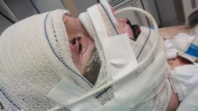 EXCLUSIVE: Story from Jam Press (Steven Johnson Syndrome) Woman left 'burning from inside out' after taking Ibuprofen devastated as doctors say vision is lost for goodA woman who was left 'burning from the inside out' and in a 17-day coma from an extreme reaction to Ibuprofen will never get her sight back, doctors have confirmed.Jaqueline Gmack took the over-the-counter medication to alleviate menstrual cramps, but soon started to experience terrifying symptoms, including blistering skin.The 32-year-old was taken to hospital and put into an induced coma, with doctors discovering her body's reaction to the medication had triggered a rare condition called Stevens-Johnson syndrome (SJS).It was a "miracle" she survived the traumatising incident, but despite 26 operations to save her vision, doctors have recently confirmed the vision in her right eye is lost for good, and vision in her left eye is extremely limited."It has taken a while for the reality to sink in – I entered a period of real mourning," Jaqueline, from Papanduva, Brazil, told NeedToKnow."I don't recognise faces on the street, I can barely see who's next to me."I can't walk alone because I can't see steps, holes, or obstacles."Jaqueline has been suffering corneal perforation – where the cornea, in the front part of the eye, has a hole or opening – since the incident, and has recently had two corneal transplants to prevent her eye from leaking.The issue means she can't regain clear vision, but the first transplant wasn't fully successful, leading to a second in February which involved having her eyelids sewn shut.She said: "I was devastated and overwhelmed because I didn't want my eyelids to be sewn, but I knew it was the only option to save my eye from further corneal damage."A few months on, the stitches eventually fell out, but doctors delivered the devastating news that she will no longer be able to see out of her right eye due to the extensive damage caused by.26 Aug 2025Pictured: WARNING, CONTAINS GRAPHIC CONTENTStory from Jam Press (Steven Johnson Syndrome) Pictured: Jaqueline Gmack in hospital.Woman left 'burning from inside out' after taking Ibuprofen devastated as doctors say vision is lost for goodA woman who was left 'burning from the inside out' and in a 17-day coma from an extreme reaction to Ibuprofen will never get her sight back, doctors have confirmed.Jaqueline Gmack took the over-the-counter medication to alleviate menstrual cramps, but soon started to experience terrifying symptoms, including blistering skin.The 32-year-old was taken to hospital and put into an induced coma, with doctors discovering her body's reaction to the medication had triggered a rare condition called Stevens-Johnson syndrome (SJS).It was a "miracle" she survived the traumatising incident, but despite 26 operations to save her vision, doctors have recently confirmed the vision in her right eye is lost for good, and vision in her left eye is extremely limited.,Image: 1031420443, License: Rights-managed, Restrictions: NO Australia, Germany, Norway, South Korea, Sweden, United Kingdom, United States, Unknown Country, Model Release: no, Pictured: Jaqueline Gmack