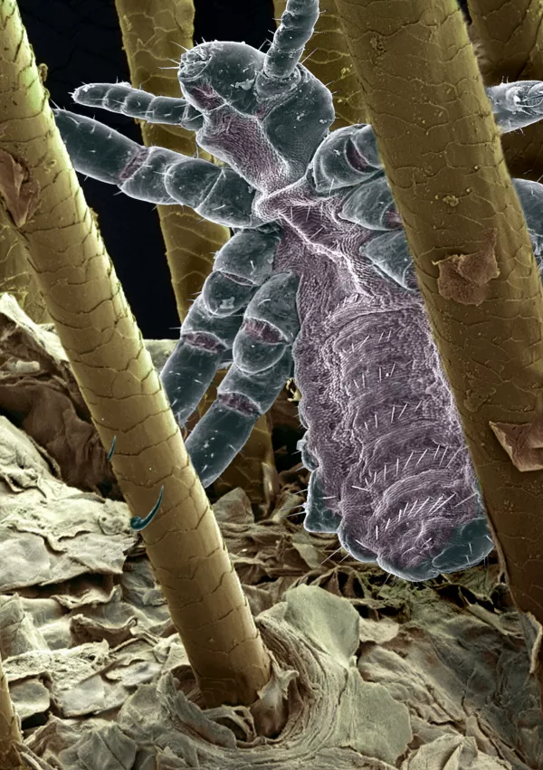 Head louse. Coloured scanning electron micrograph (SEM) of head louse (Pediculus humanus capitis) clinging to human hairs. Head lice measure 2-3 millimetres in length. They live in the hair on the head and suck blood from the scalp, causing intense itching. The itching provokes scratching, which can lead to scalp inflammation or dermatitis. Treatment is with medicated shampoo. Magnification: x180 when printed at 10 centimetres tall.,Image: 103053804, License: Rights-managed, Restrictions:, Model Release: no / Foto: Profimedia