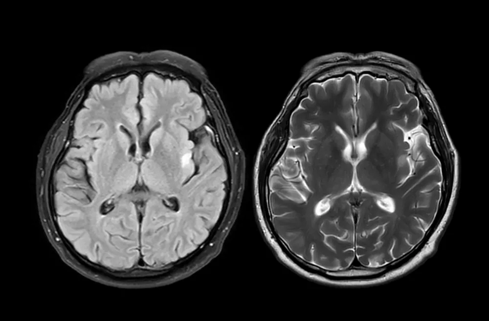 MRI brain scan axial T1W for detect Brain diseases sush as stroke disease, Brain tumors and Infections.