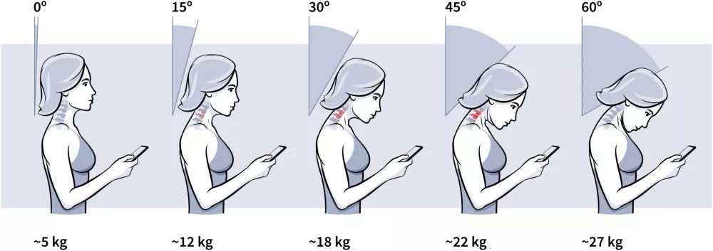 Slika prikazuje obremenjenost vratu glede na naklon glave. / Foto: Istock