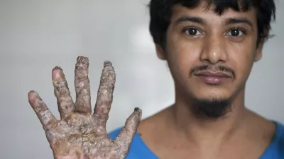 DHAKA, BANGLADESH - 2016/08/09: Abul Vajondar was identified with epidermodysplasia verruciformis a rare skin disease. After surgery he is better now and under treatment at the Dhaka Medical College Hospital. Abul Vajondar has been suffering bark-like warts on his hands and feet since four years. (Photo by K M Asad/LightRocket via Getty Images) / Foto: K M Asad