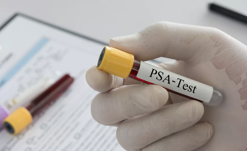 Presejalni test PSA&nbsp;analizira vrednost za prostato specifičnega antigena. / Foto: Getty Images