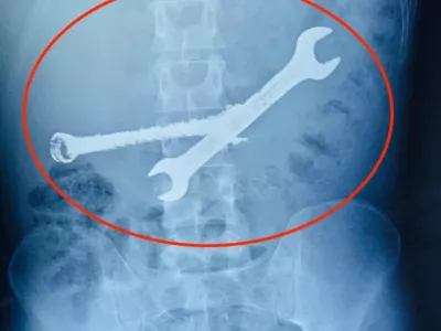 Story from Jam Press (Toothbrushes In Stomach)Pictured: An x-ray showing the two spanners inside the 26-year-old man's stomach.VIDEO: Tummy ache-suffering man leaves docs stunned as they find seven toothbrushes and two spanners in his stomachA tummy-ache-suffering man left doctors stunned after they found seven toothbrushes and two spanners in his stomach.They had been there for weeks.The 26-year-old was admitted to the hospital after complaining of chronic abdominal pain.Doctors were stunned to find multiple foreign objects inside his stomach.An endoscopy was attempted but failed to remove the objects.A senior gastroenterologist and his team then decided to proceed with open surgery.The operation lasted more than two hours in Jaipur, Rajasthan, India, as reported by What's The Jam.According to the doctors, the man's stomach was like a dustbin, and the objects could have been life-threatening.The patient from Bhilwara district was said to have a habit of swallowing iron tools and toothbrushes.He had swallowed these objects a month ago.But after the operation, his condition was described as stable.ENDSEDITOR'S NOTE: Video Usage Licence: (PROFESSIONAL PARTNER) We have obtained this material from a professional partner for use by our news media clients (company press release / other media agency).Video Restrictions: None.,Image: 1062303507, License: Rights-managed, Restrictions: EDITOR'S NOTE: Video Usage Licence: (PROFESSIONAL PARTNER) We have obtained this material from a professional partner for use by our news media clients (company press release / other media agency).Video Restrictions: None., Model Release: no