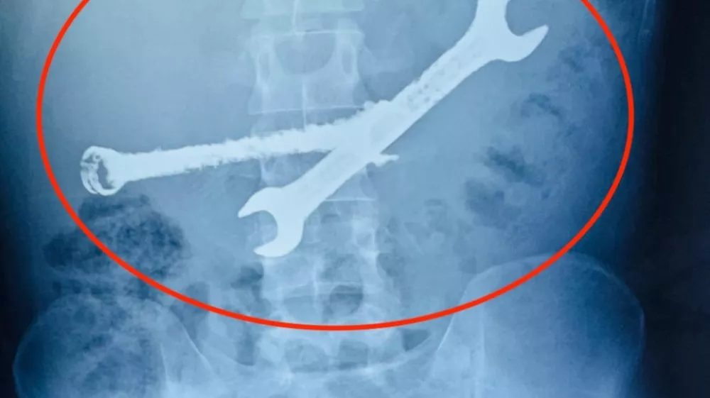 Story from Jam Press (Toothbrushes In Stomach)Pictured: An x-ray showing the two spanners inside the 26-year-old man's stomach.VIDEO: Tummy ache-suffering man leaves docs stunned as they find seven toothbrushes and two spanners in his stomachA tummy-ache-suffering man left doctors stunned after they found seven toothbrushes and two spanners in his stomach.They had been there for weeks.The 26-year-old was admitted to the hospital after complaining of chronic abdominal pain.Doctors were stunned to find multiple foreign objects inside his stomach.An endoscopy was attempted but failed to remove the objects.A senior gastroenterologist and his team then decided to proceed with open surgery.The operation lasted more than two hours in Jaipur, Rajasthan, India, as reported by What's The Jam.According to the doctors, the man's stomach was like a dustbin, and the objects could have been life-threatening.The patient from Bhilwara district was said to have a habit of swallowing iron tools and toothbrushes.He had swallowed these objects a month ago.But after the operation, his condition was described as stable.ENDSEDITOR'S NOTE: Video Usage Licence: (PROFESSIONAL PARTNER) We have obtained this material from a professional partner for use by our news media clients (company press release / other media agency).Video Restrictions: None.,Image: 1062303507, License: Rights-managed, Restrictions: EDITOR'S NOTE: Video Usage Licence: (PROFESSIONAL PARTNER) We have obtained this material from a professional partner for use by our news media clients (company press release / other media agency).Video Restrictions: None., Model Release: no