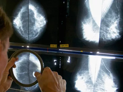 Med najpogostej&scaron;imi raki pri nas je tudi rak dojk. / Foto: AP