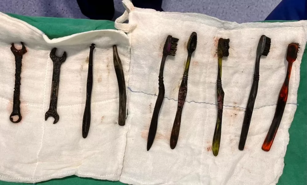 EXCLUSIVE: Story from Jam Press (Toothbrushes In Stomach)Pictured: A video grab of the doctors removing the seven toothbrushes and two spanners from inside the 26-year-old man's stomach.VIDEO: Tummy ache-suffering man leaves docs stunned as they find seven toothbrushes and two spanners in his stomachA tummy-ache-suffering man left doctors stunned after they found seven toothbrushes and two spanners in his stomach.They had been there for weeks.The 26-year-old was admitted to the hospital after complaining of chronic abdominal pain.Doctors were stunned to find multiple foreign objects inside his stomach.An endoscopy was attempted but failed to remove the objects.A senior gastroenterologist and his team then decided to proceed with open surgery.The operation lasted more than two hours in Jaipur, Rajasthan, India, as reported by What's The Jam.According to the doctors, the man's stomach was like a dustbin, and the objects could have been life-threatening.The patient from Bhilwara district was said to have a habit of swallowing iron tools and toothbrushes.He had swallowed these objects a month ago.But after the operation, his condition was described as stable.ENDSEDITOR'S NOTE: Video Usage Licence: (PROFESSIONAL PARTNER) We have obtained this material from a professional partner for use by our news media clients (company press release / other media agency).Video Restrictions: None.30 Dec 2025Pictured: Story from Jam Press (Toothbrushes In Stomach)Pictured: The seven toothbrushes and two spanners found inside the 26-year-old man's stomach.VIDEO: Tummy ache-suffering man leaves docs stunned as they find seven toothbrushes and two spanners in his stomachA tummy-ache-suffering man left doctors stunned after they found seven toothbrushes and two spanners in his stomach.They had been there for weeks.The 26-year-old was admitted to the hospital after complaining of chronic abdominal pain.Doctors were stunned to find multiple foreign objects inside his stomach.An endoscopy was attempted but failed to remove the objects.A senior gastroenterologist and his team then decided to proceed with open surgery.The operation lasted more than two hours in Jaipur, Rajasthan, India, as reported by What's The Jam.According to the doctors, the man's stomach was like a dustbin, and the objects could have been life-threatening.The patient from Bhilwara district was said to have a habit.,Image: 1062304656, License: Rights-managed, Restrictions: NO Australia, Germany, Norway, South Korea, Sweden, United Kingdom, United States, Unknown Country, Model Release: no