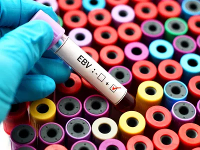 Vzorec krvi, ki je pokazal na prisotnost virusa Epstein-Barr. / Foto: Istock