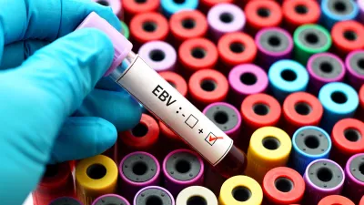 Vzorec krvi, ki je pokazal na prisotnost virusa Epstein-Barr. / Foto: Istock