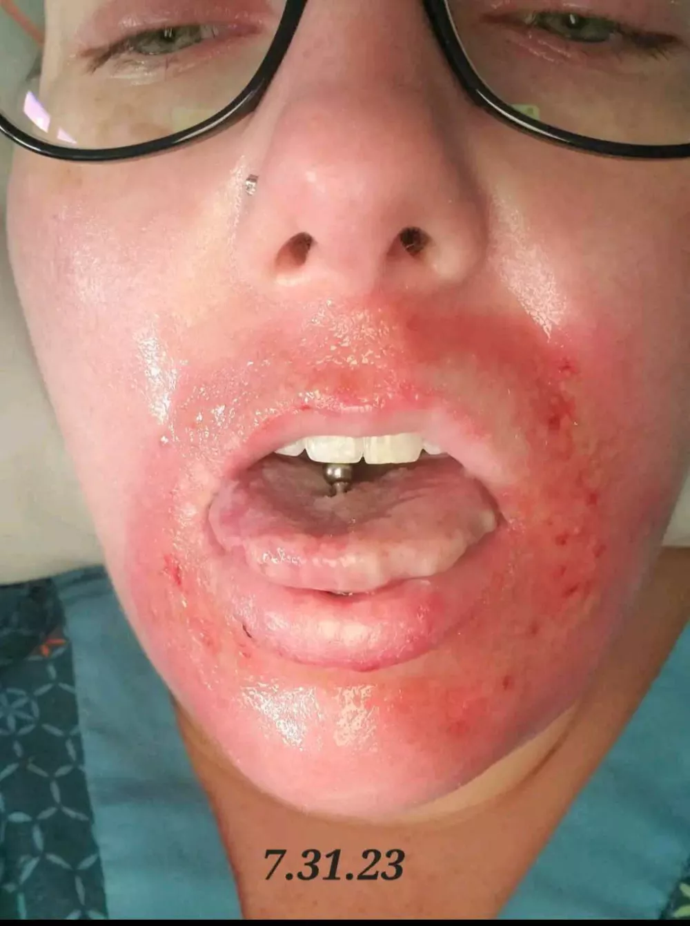 EXCLUSIVE: Story from Jam Press (Vampire Protects Skin)Pictured: A video grab of Emily Richardson speaking about the differences of UV protection from black and white fabrics.VIDEO: 'A MINUTE in the sun could kill me after ear infection medicine triggered rare syndrome'A woman calls herself a 'real-life vampire' after a rare reaction to medication left her unable to be in the sunlight for more than seconds.Emily Richardson has a rare condition called Stevens-Johnson Syndrome (SJS), which was triggered by various medications, including a common antibiotic, and "destroyed" her immune system.The result? She has become incredibly sensitive to the sun, and says being in direct exposure for even one minute would likely kill her, while just 30 seconds would land her in hospital.The 36-year-old's life has changed dramatically since the reaction became more severe and specific to sun exposure following a bout of Covid five years ago.Since, she has been forced to largely remain indoors, and leaving the home at nighttime involves a huge amount of planning."SJS attacks the mucosal membranes, specifically the areas that have been affected before, and it also spread," Emily, who is from Nashville, Tennessee, told NeedToKnow."It causes the top layer of skin to die and fall off."The longer the exposure, the worse the reaction."30 seconds of sun exposure will put me in the hospital &ndash; a minute would probably kill me."UV protection is the only way I can survive."Stevens-Johnson Syndrome is a rare, severe reaction, usually to medication or infection, causing flu-like symptoms followed by a painful, blistering rash that peels the top layer of skin and damages mucous membranes.Emily originally reacted to amoxicillin, a common penicillin antibiotic, prescribed to treat an ear infection.She reacted again to antibiotics for suspected bronchitis, triggering SJS again.But it wasn't until 2021 that things took a drastic turn for the worse, with Covid triggering the same re.16 Jan 2026Pictured: Story from Jam Press (Vampire Protects Skin)Pictured: Emily Richardson after a bout of Stevens-Johnson Syndrome (SJS).VIDEO: 'A MINUTE in the sun could kill me after ear infection medicine triggered rare syndrome'A woman calls herself a 'real-life vampire' after a rare reaction to medication left her unable to be in the sunlight for more than seconds.Emily Richardson has a rare condition called Stevens-Johnson Syndrome (SJS), which was triggered by various medications, including a common antibiotic, and "destroyed" her immune system.The result? She has become incredibly sensitive to the sun, and says being in direct exposure for even one minute would likely kill her, while just 30 seconds would land her in hospital.The 36-year-old's life has changed dramatically since the reaction became more severe and specific to sun exposure following a bout of Covid five years ago.Since, she has been forced to largely remain indoors, and leaving the home at nighttime involves a huge a.,Image: 1066476439, License: Rights-managed, Restrictions: NO Australia, Germany, Norway, South Korea, Sweden, United Kingdom, United States, Unknown Country, Model Release: no