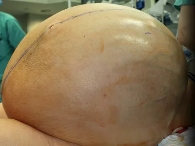 Veliki tumor na jajčnikih